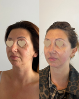 [IDF] MASTERCLASS HIFU AVANCÉ - Protocoles Signature & Résultats Instantanés｜11/01/2026